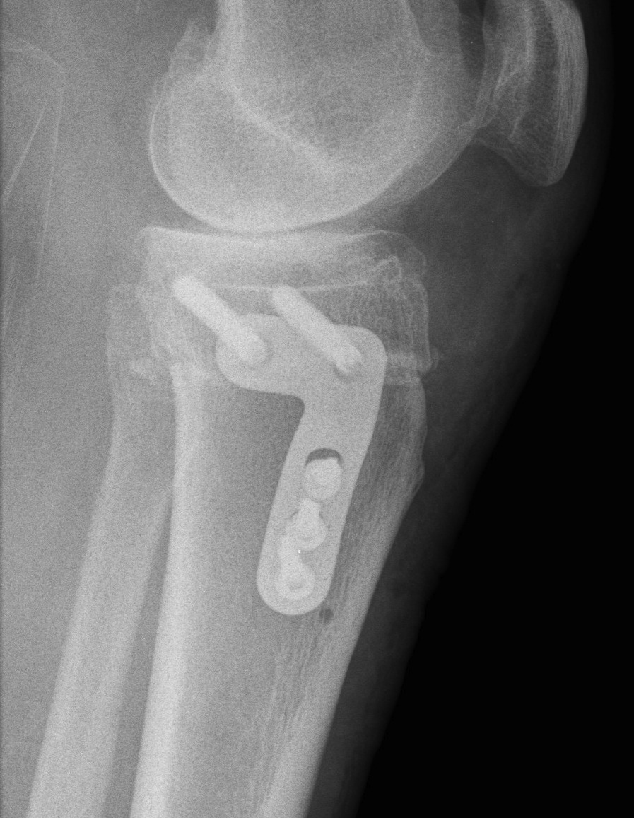 HTO Lateral Closing Wedge Lateral